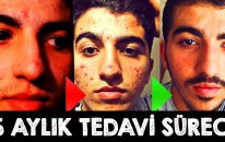 Sivilce Tedavim Boyunca Kayıt Aldım - Roaccutane Tedavim