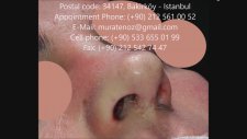Kemik Kırılmadan Burun Estetiği (Nose Job Without Breaking Bone)