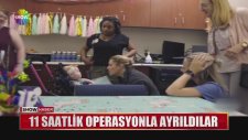Yapışık İkizlerin Yürek Isıtan Hikayesi