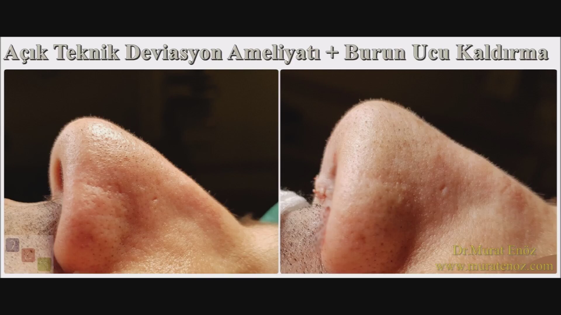 İple Burun Ucu Kaldırma: İple Burun Estetiği İple Burun Ucu Kaldırma: İple Burun Estetiği