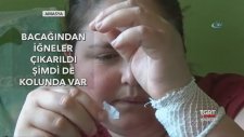 Genç Kızın Vücudu İğne Üretiyor
