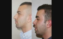 Op Dr Mustafa Ali Yanık burun şikayet ve çözümleri ve hasta sonuçları