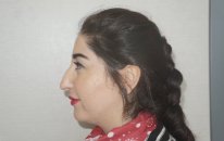 Op Dr Mustafa Ali Yanık burun şikayet ve çözümleri ve hasta sonuçları