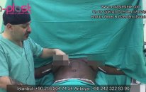 Kombine Vücut Estetik Ameliyatı | Op Dr Gökhan Özerdem Antalya