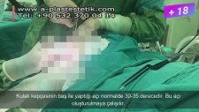 Kepçe Kulak Estetiği Ameliyatı | Prof Dr Ömer Refik Özerdem
