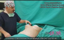 Kombine Anne Estetiği ( Mommy Makeover) Nasıl Uygulanır?