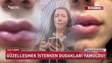 Güzellik Uğruna Dudakları Yamulan Kadın