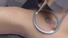 Lazerle Dövme Sildirme İşlemi