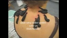 Sülük Tedavisi