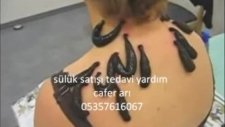 sülükle tedavi sülükle tedavi yöntemi sülükle romatizma tedavisi sülükler satış