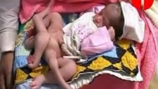 Altı Bacaklı Bebek Doğdu!