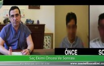 Saç Ekimi Öncesi Sonrası Op Dr Ali Mezdeği