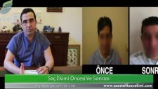 Saç Ekimi Öncesi Sonrası Op Dr Ali Mezdeği