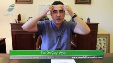 Alın Bölgesine Saç Ekimi Op Dr Ali Mezdeği