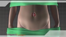 Hamilelik Sonrası Karın Germe - Liposuctin Yağ Aldırma
