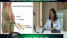 Liposuction Teknikleri Nelerdir?