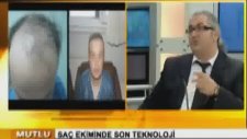Saç Ekimi
