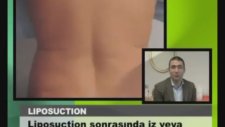 Teoman Doğan : Liposuction Sonrası Masaj