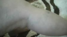Süleyman Çobanoğlu Varis Tedavisi