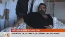 Mide Küçültme Ameliyatı ile Kalıcı Zayıflama Kilo Verme