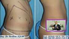 Yağ Alma İşlemi Liposuction İle Nasıl Yapılır?