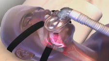 Cpap Cihazları Uyku Apnesini Nasıl Engeller ?