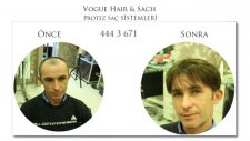 Protez Saç Uygulama Öncesi ve Sonrası VOGUE HAIR | SACH Protez Saç Merkezi