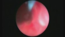 Laser Endopyelotomy - Professor Doctor Mete KİLCİLER