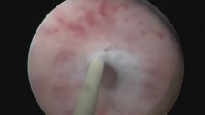 Profesör Doktor Mete Kilciler - Üretra Darlığı Ameliyatı - Internal Uretrotomi