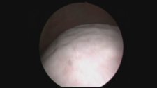 Profesör Doktor Mete Kilciler - Uterus Myomunun Mesaneye Dıştan Basışı