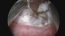 Professor Doctor Mete Kilciler - Bladder Tumour in The Diverticulum