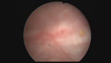 Professor Doctor Mete Kilciler - Cystoscopy : Bph Bladder Stones
