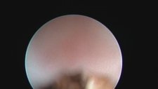 Professor Doctor Mete Kilciler - Management Of Ureteral Stone