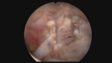 Professor Doctor Mete Kilciler - Prostate Stones