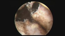 Professor Doctor Mete KİLCİLER - Transurethral Incision Of Prostate - TUIP