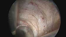 Professor Doctor Mete Kilciler - Transurethral Plasmakinetic Resection Of The Prostate (tur-p)