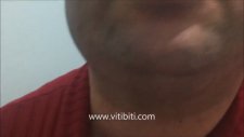Vitiligo Hastalığı Artık Kaderiniz Olmasın