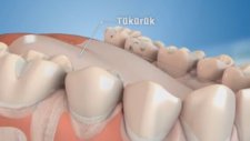 Diş Çürükleri