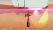 Me Elos ( Ipl+rf ) Lazer Epilasyon Cihazı