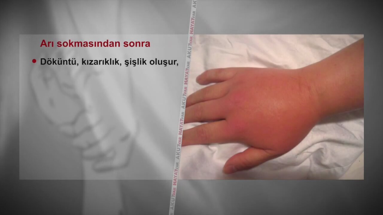Böcek Sokmalarında İlk Yapılması Gerekenler Böcek Sokmalarında İlk Yapılması Gerekenler