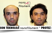 Nanofilament Protez Saç