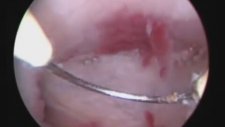 Yshape Y Uterus Histeroskopi