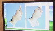 Ameliyat Öncesinde Hastalar Burnunun Nasıl Olacağını Görebilirler mi? - Op.Dr.Süreyya Şelendir