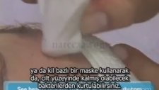 Sivilceler Nasıl Patlatılır?