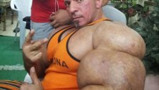 Fazla Steroidin Etkileri