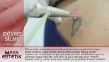 Lazerle Dövme Sildirme - Maya Estetik
