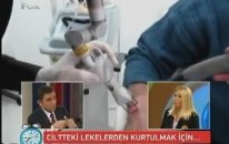 Radyofrekanslı Fraksiyonel co2 Lazer ile Sivilce İzleri ve Cilt Lekeleri Nasıl Geçer
