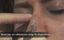 Dolgu Ve Botoks İle Ameliyatsız Burun Estetigi