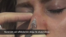 Dolgu Ve Botoks İle Ameliyatsız Burun Estetigi
