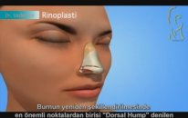 Rinoplasti (Burun Estetigi Ameliyatı) Nasıl Yapılır?